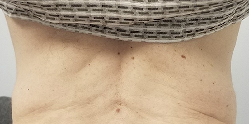 Minimally Invasive Body Treatments After Picture
