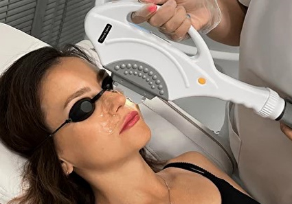 Woman receiving IPL Laser Treatments