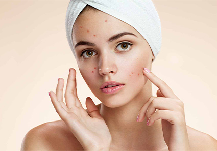 BeyondSkin MedSpa Acne Facial