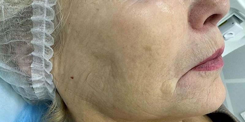 IPL Laser Treatment face after