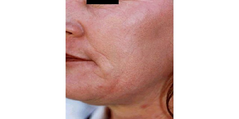 Full Skin Resurfacing 1 after