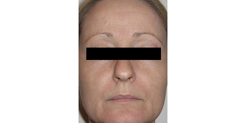 Full Skin Resurfacing 2 after