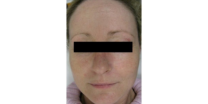 Full Skin Resurfacing 2 before