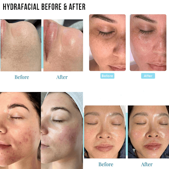 Hydrafacial Before and After