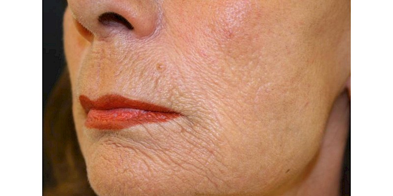 Fractional Skin Resurfacing after