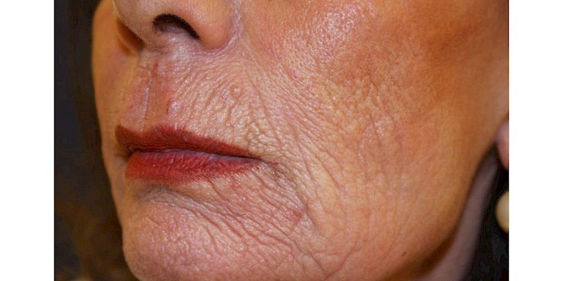 Fractional Skin Resurfacing before