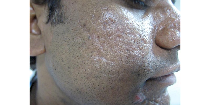 Acne Scars after