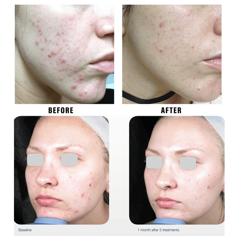 Acne IPL Treatment Before and After