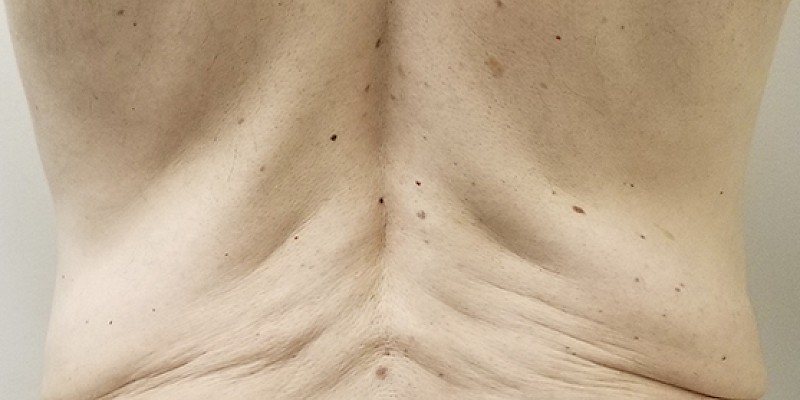 Minimally Invasive Body Treatments Before Picture