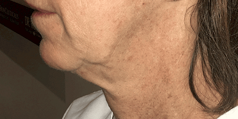 Minimally Invasive Neck Treatments After Picture
