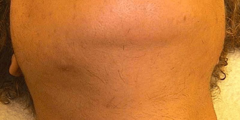 Laser Hair Removal after
