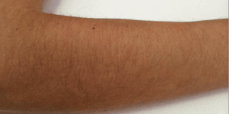Laser hair Removal Forearm before