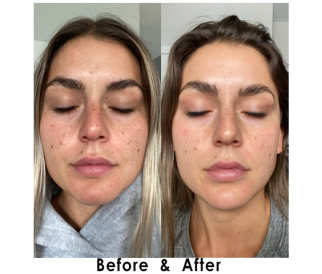 IPL Photofacial Before and After