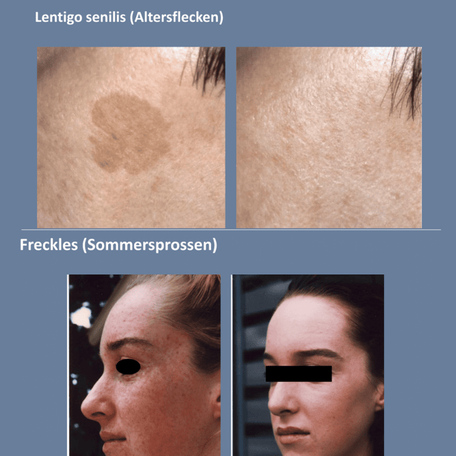 Erbium Before and After Results